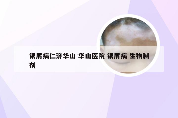 银屑病仁济华山 华山医院 银屑病 生物制剂