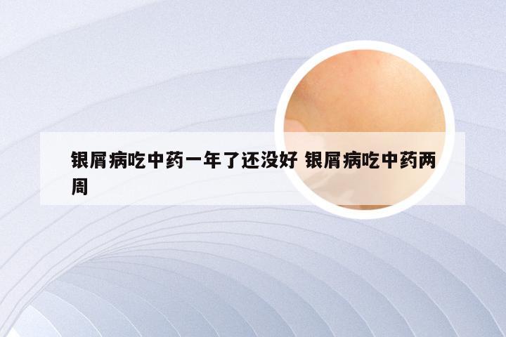 银屑病吃中药一年了还没好 银屑病吃中药两周
