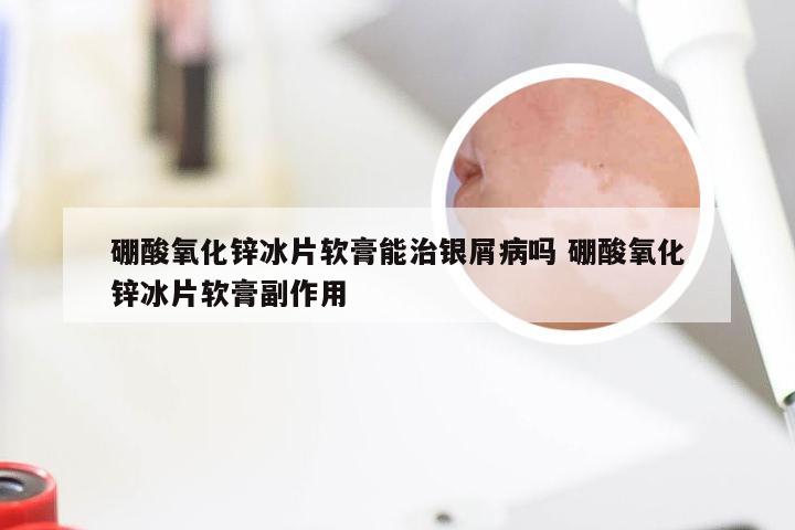 硼酸氧化锌冰片软膏能治银屑病吗 硼酸氧化锌冰片软膏副作用