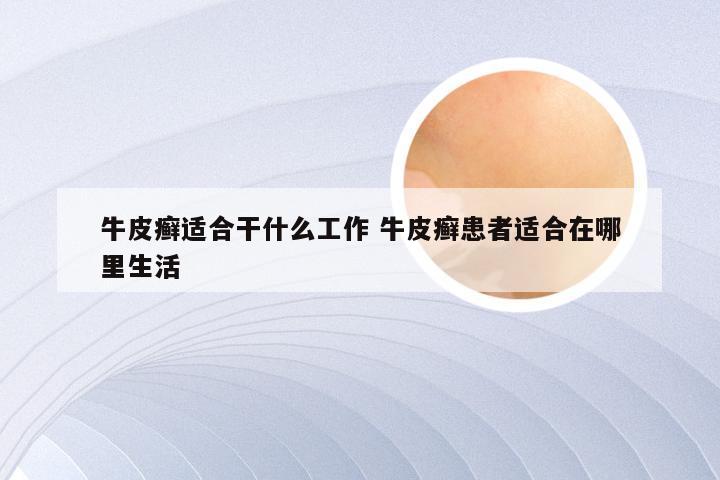 牛皮癣适合干什么工作 牛皮癣患者适合在哪里生活