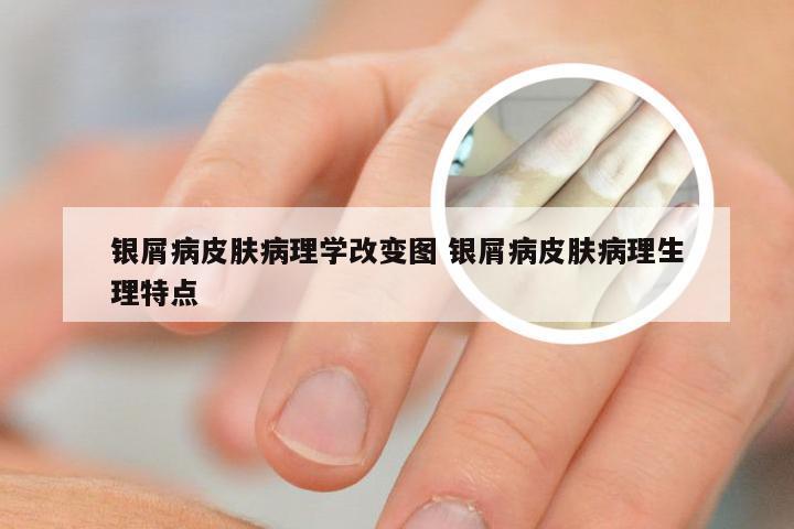 银屑病皮肤病理学改变图 银屑病皮肤病理生理特点