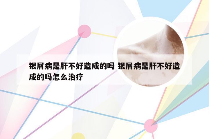 银屑病是肝不好造成的吗 银屑病是肝不好造成的吗怎么治疗