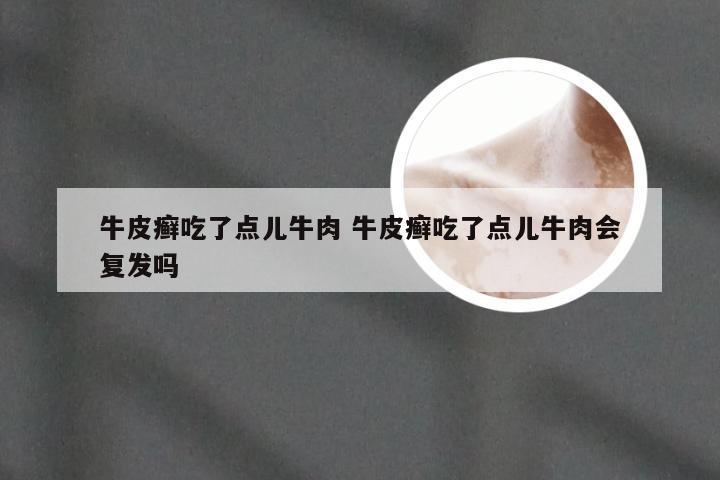 牛皮癣吃了点儿牛肉 牛皮癣吃了点儿牛肉会复发吗