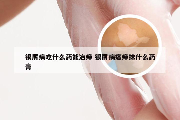 银屑病吃什么药能冶痒 银屑病瘙痒抹什么药膏