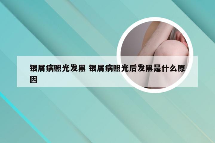 银屑病照光发黑 银屑病照光后发黑是什么原因