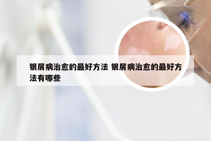 银屑病治愈的最好方法 银屑病治愈的最好方法有哪些