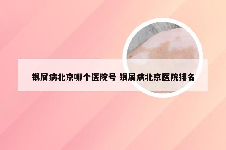 银屑病北京哪个医院号 银屑病北京医院排名
