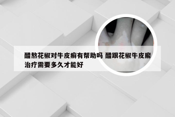 醋熬花椒对牛皮癣有帮助吗 醋跟花椒牛皮廨治疗需要多久才能好