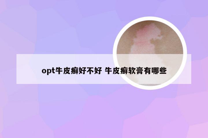 opt牛皮癣好不好 牛皮癣软膏有哪些