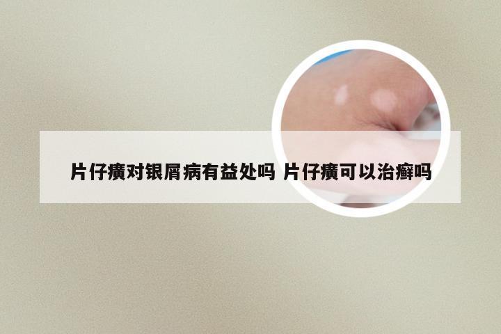 片仔癀对银屑病有益处吗 片仔癀可以治癣吗