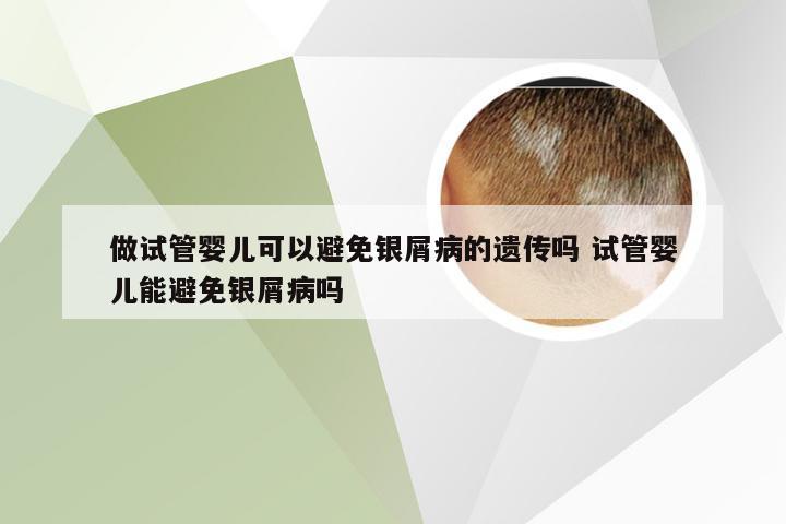 做试管婴儿可以避免银屑病的遗传吗 试管婴儿能避免银屑病吗