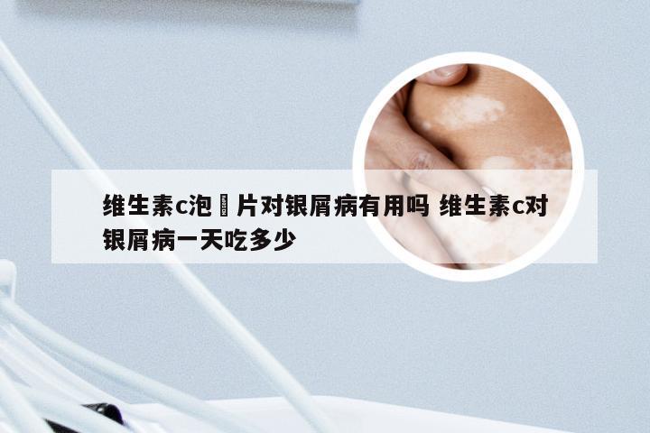 维生素c泡腃片对银屑病有用吗 维生素c对银屑病一天吃多少