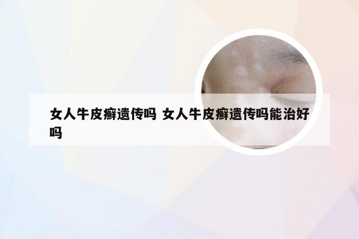女人牛皮癣遗传吗 女人牛皮癣遗传吗能治好吗