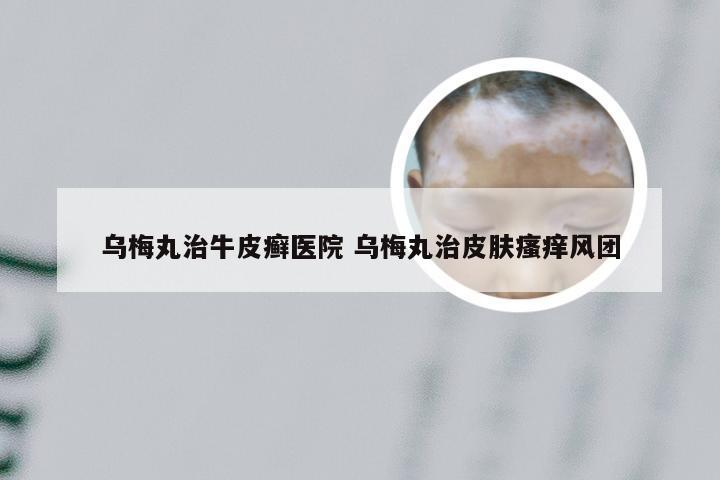 乌梅丸治牛皮癣医院 乌梅丸治皮肤瘙痒风团