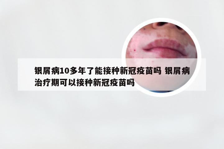 银屑病10多年了能接种新冠疫苗吗 银屑病治疗期可以接种新冠疫苗吗