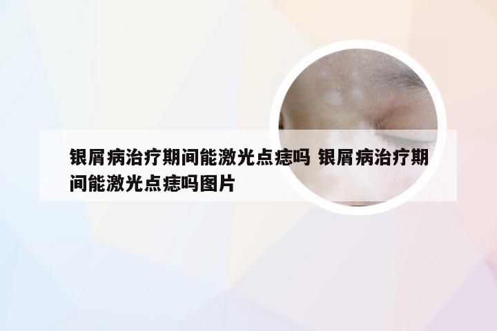 银屑病治疗期间能激光点痣吗 银屑病治疗期间能激光点痣吗图片