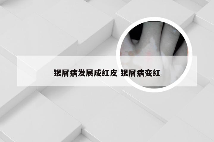 银屑病发展成红皮 银屑病变红