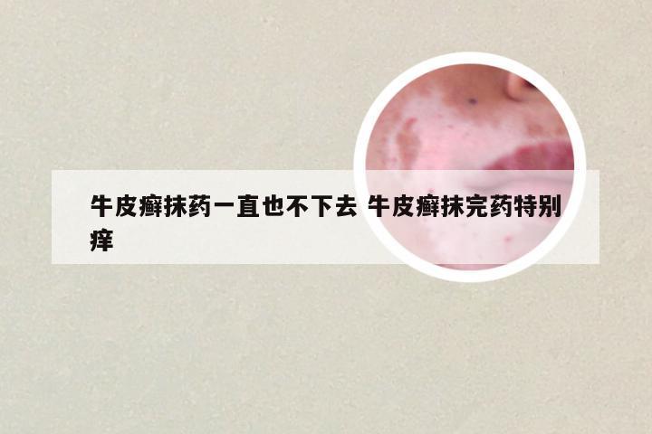 牛皮癣抹药一直也不下去 牛皮癣抹完药特别痒