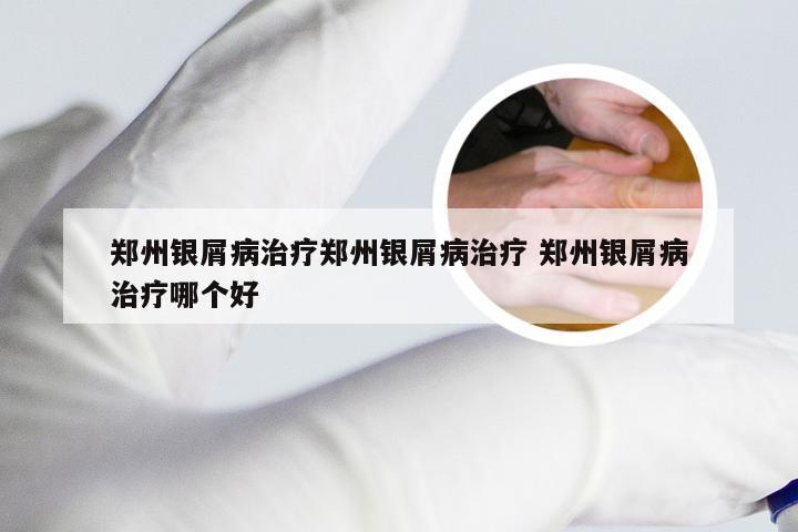 郑州银屑病治疗郑州银屑病治疗 郑州银屑病治疗哪个好