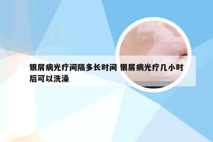 银屑病光疗间隔多长时间 银屑病光疗几小时后可以洗澡