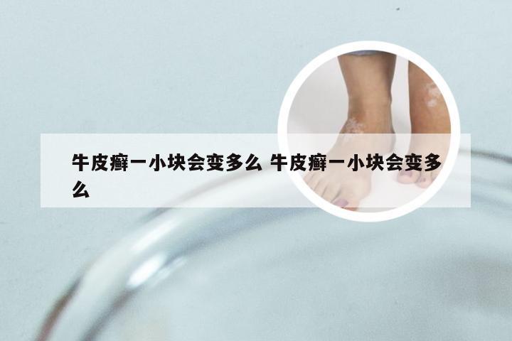 牛皮癣一小块会变多么 牛皮癣一小块会变多么