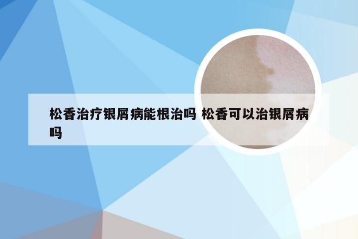 松香治疗银屑病能根治吗 松香可以治银屑病吗