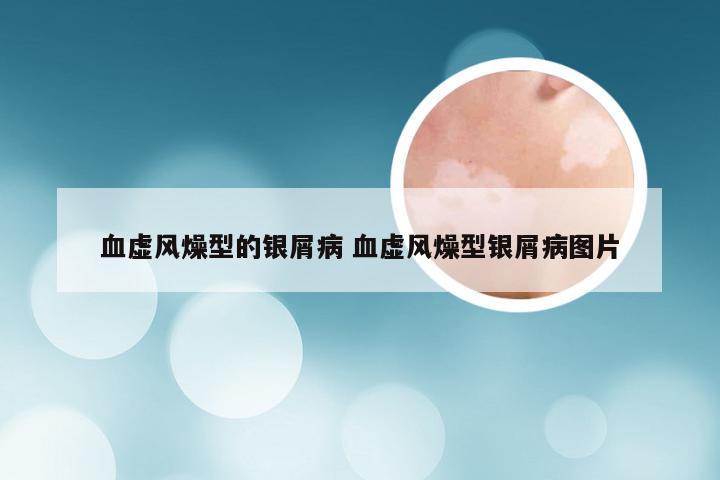 血虚风燥型的银屑病 血虚风燥型银屑病图片