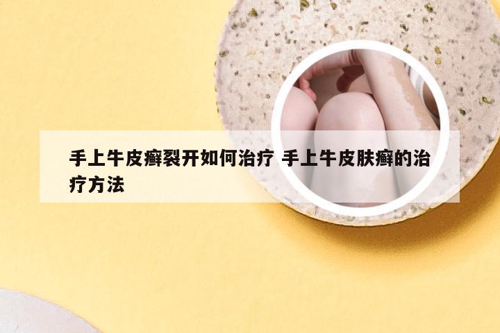 手上牛皮癣裂开如何治疗 手上牛皮肤癣的治疗方法