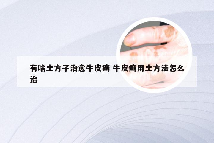 有啥土方子治愈牛皮癣 牛皮癣用土方法怎么治
