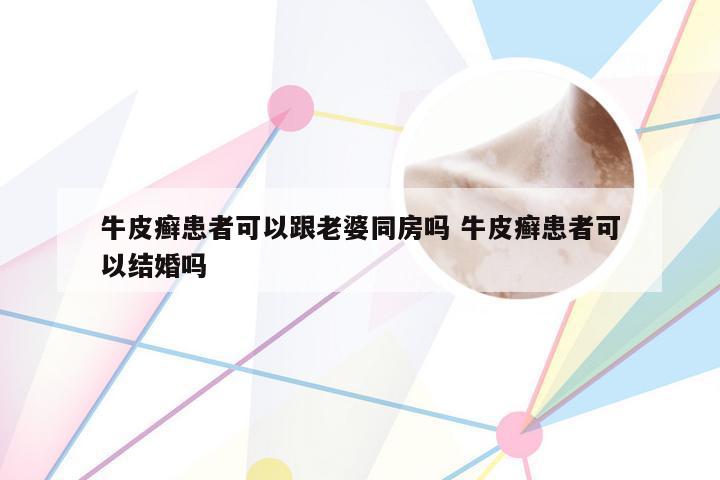 牛皮癣患者可以跟老婆同房吗 牛皮癣患者可以结婚吗