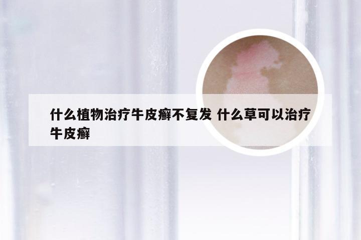 什么植物治疗牛皮癣不复发 什么草可以治疗牛皮癣