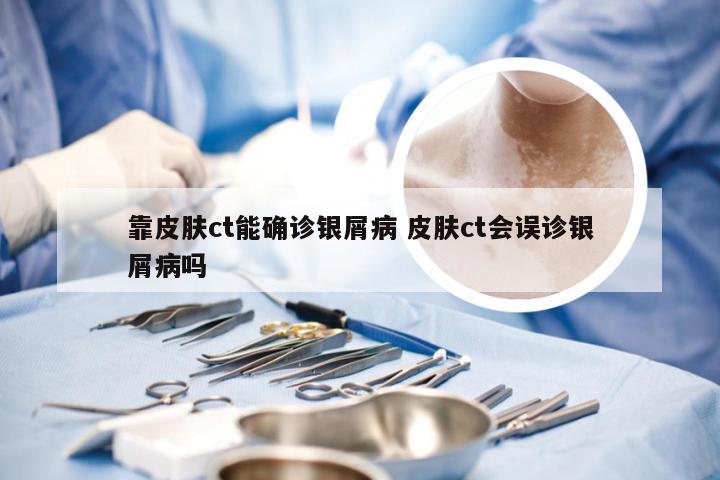 靠皮肤ct能确诊银屑病 皮肤ct会误诊银屑病吗