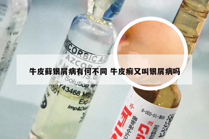 牛皮藓银屑病有何不同 牛皮癣又叫银屑病吗