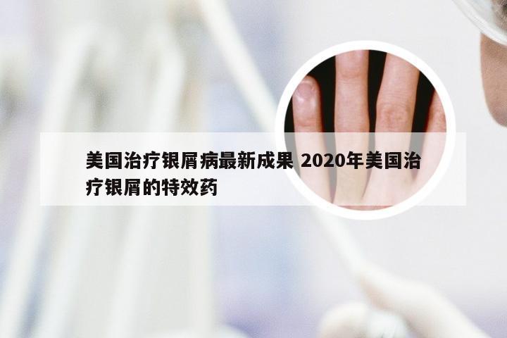 美国治疗银屑病最新成果 2020年美国治疗银屑的特效药