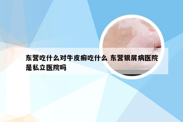 东营吃什么对牛皮癣吃什么 东营银屑病医院是私立医院吗