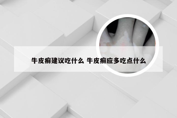 牛皮癣建议吃什么 牛皮癣应多吃点什么