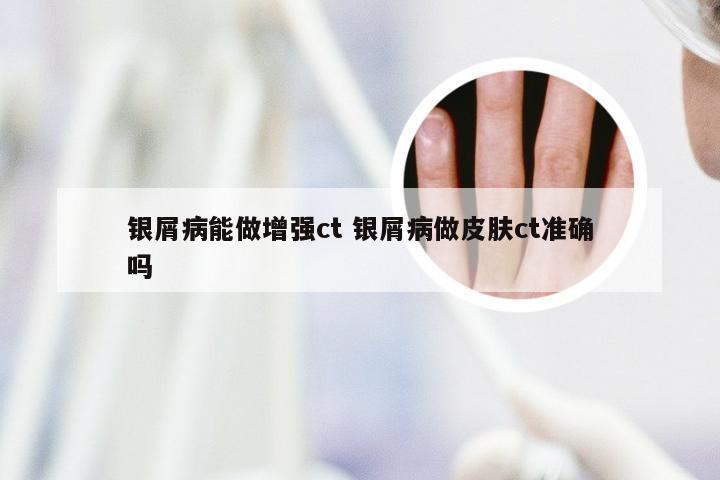 银屑病能做增强ct 银屑病做皮肤ct准确吗