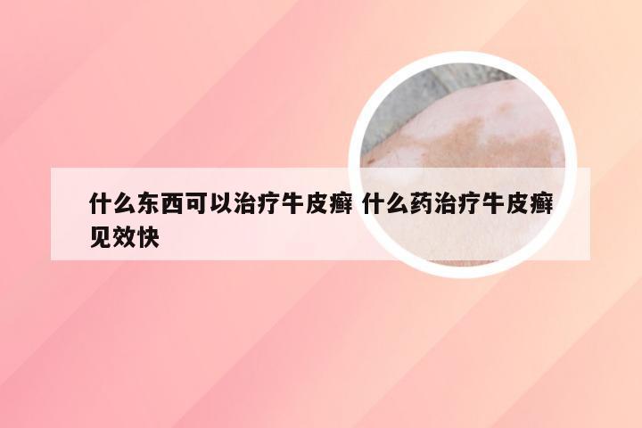 什么东西可以治疗牛皮癣 什么药治疗牛皮癣见效快