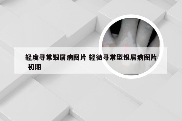 轻度寻常银屑病图片 轻微寻常型银屑病图片 初期