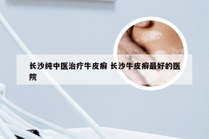 长沙纯中医治疗牛皮癣 长沙牛皮癣最好的医院