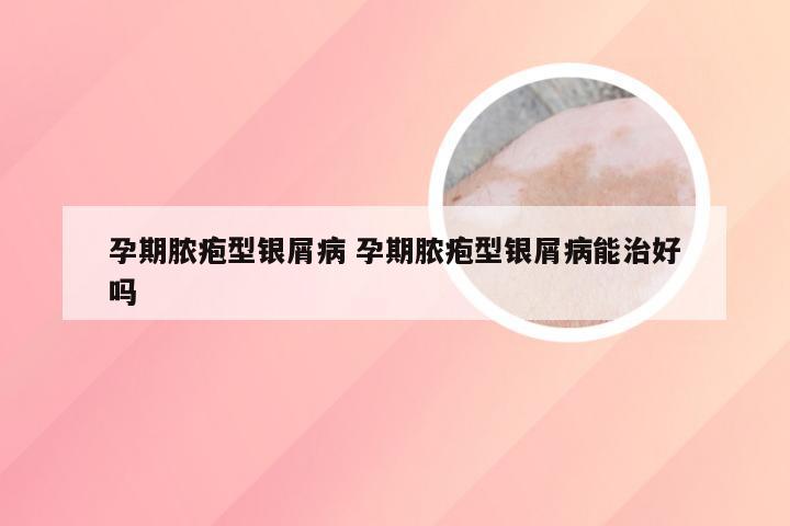 孕期脓疱型银屑病 孕期脓疱型银屑病能治好吗
