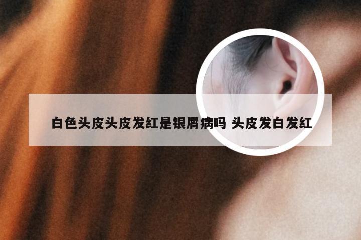 白色头皮头皮发红是银屑病吗 头皮发白发红