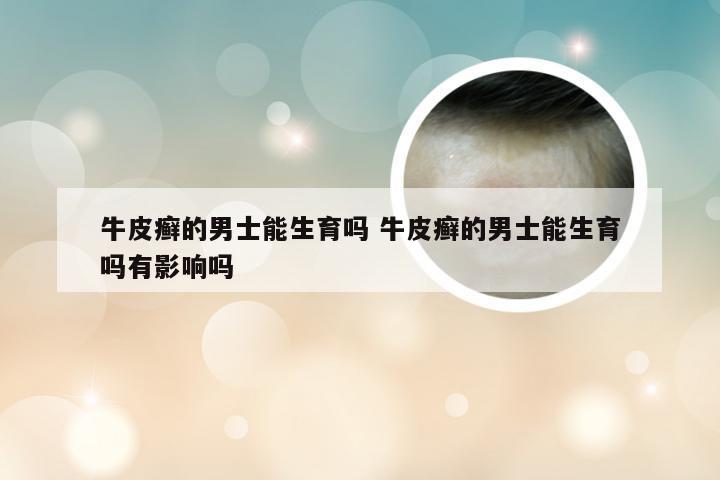 牛皮癣的男士能生育吗 牛皮癣的男士能生育吗有影响吗