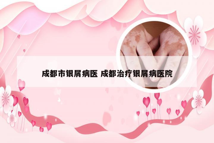 成都市银屑病医 成都治疗银屑病医院