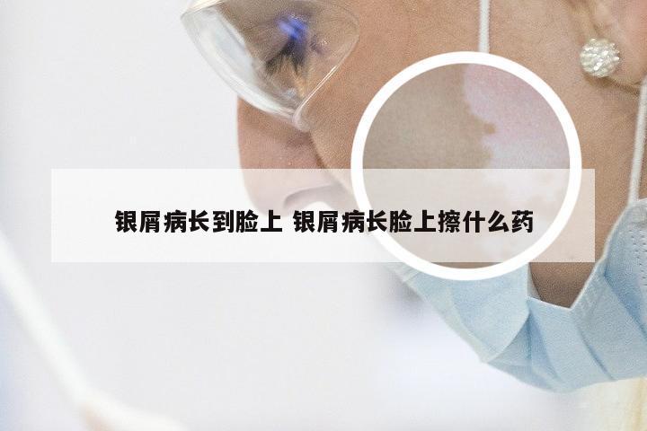 银屑病长到脸上 银屑病长脸上擦什么药