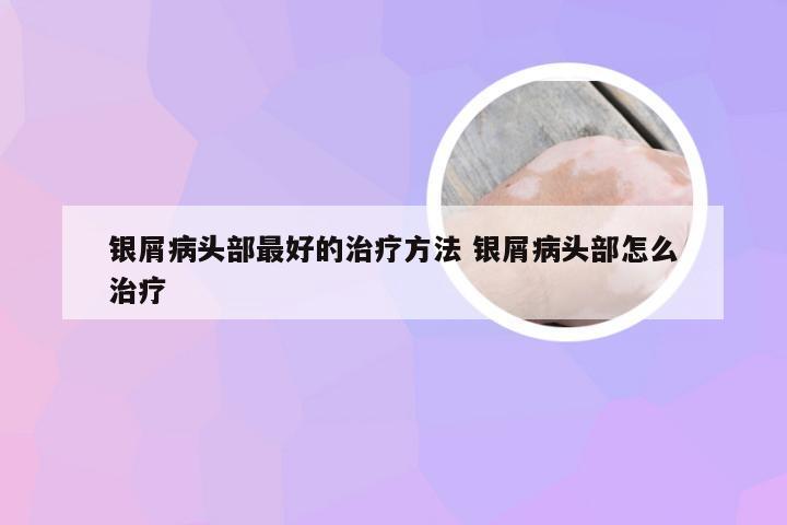 银屑病头部最好的治疗方法 银屑病头部怎么治疗
