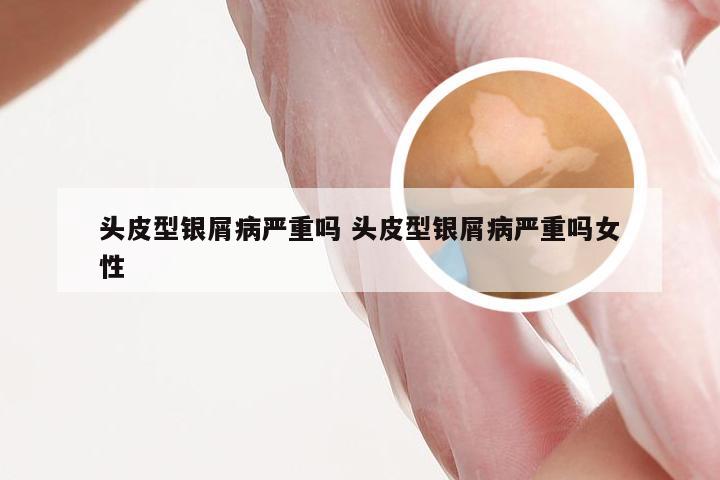 头皮型银屑病严重吗 头皮型银屑病严重吗女性