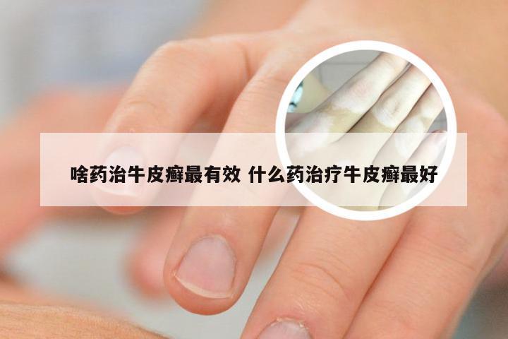 啥药治牛皮癣最有效 什么药治疗牛皮癣最好