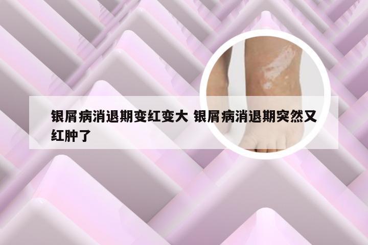 银屑病消退期变红变大 银屑病消退期突然又红肿了