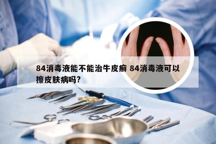 84消毒液能不能治牛皮癣 84消毒液可以擦皮肤病吗?